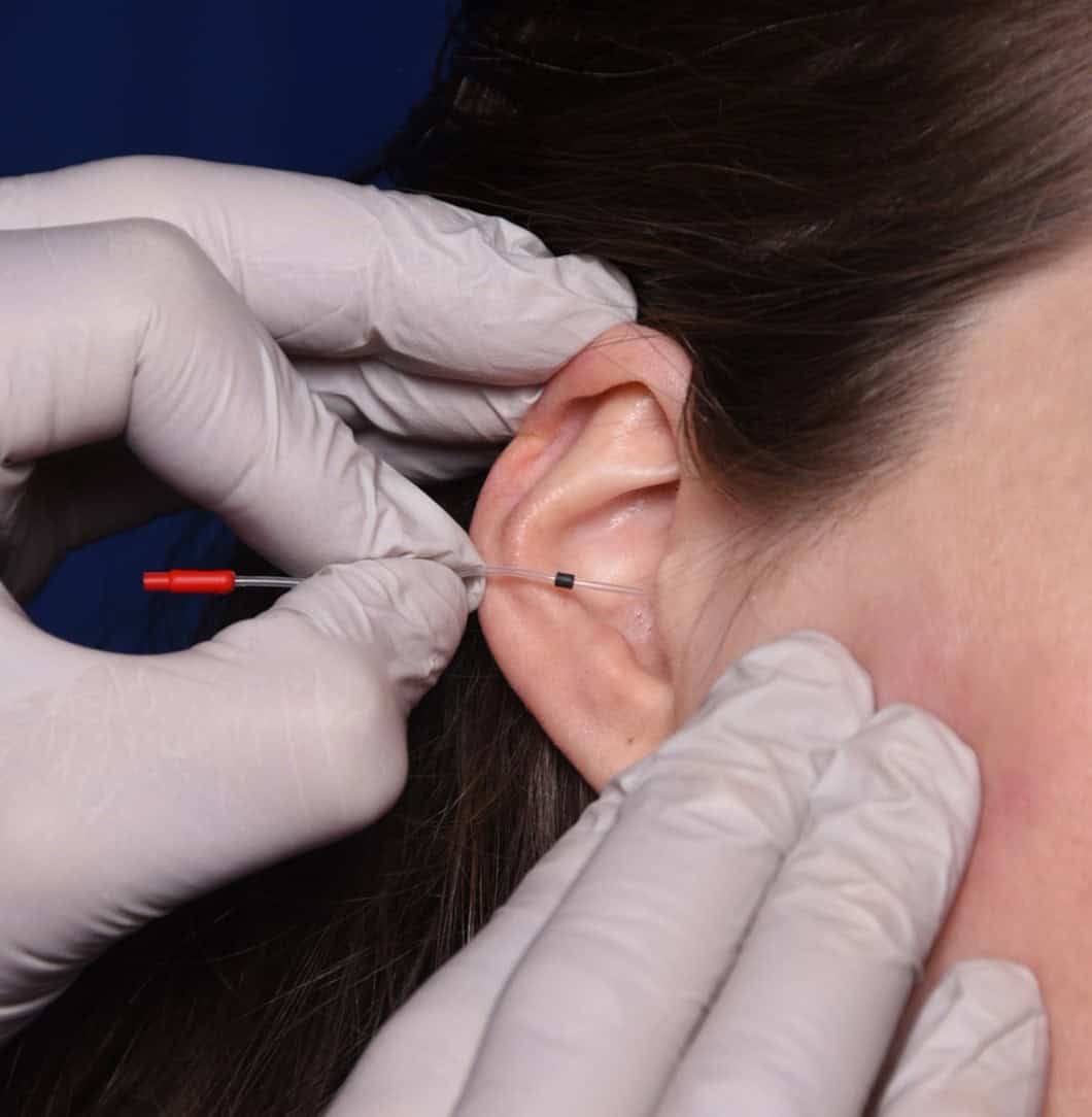 Medical professional inserting ear implant using bridge-and-brace technique for ear treatment.